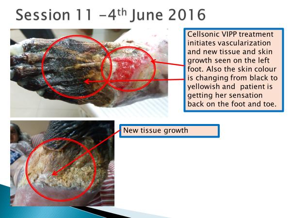 Figure 11. Session 11, 4 th June 2016 Conventional wound healing has no means of increasing blood flow and killing all infections whatever and wherever they are.