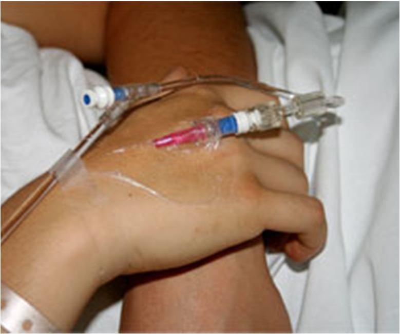 Peripheral venous catheter Risk of thrombophlebitis and accidental removal Discouraged in HPN OPAT guidelines Tice e.a. 2004: appropriate for patients with good vein status short course of therapy Agent with low potential for causing phlebitis or soft tissue damage Chapman, e.