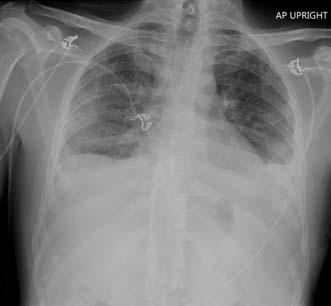 Background History (2) May September 2017 9 Condition continues to worsen Develops cough, fevers, night sweats, abdominal distension, weight loss, anorexia CXR December 5, 2017 October December 2017