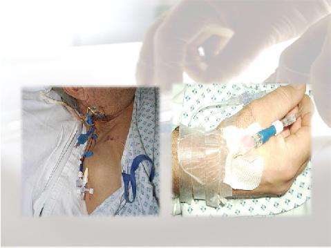 Prevention of infection in IV Therapy Aseptic Non Touch Technique (ANTT ) to prepare IVs and when administering IVs. Hand Hygiene before preparing IVs and when administering IVs, i.e. Aseptic procedure.