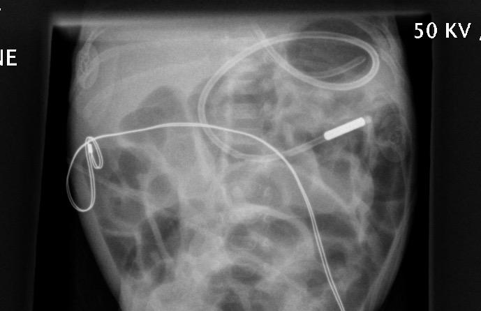seen to curl in small bowel loops gently withdraw as necessary. You can measure the exact distance to withdraw on the X-ray.