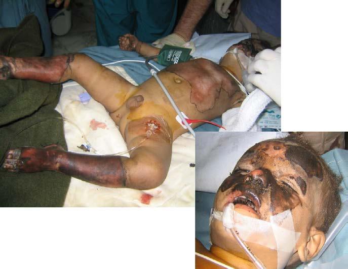 Frequently encountered, often with blast injuries Complex patients Sepsis MOF Case #4: Pediatric Burns Require multiple