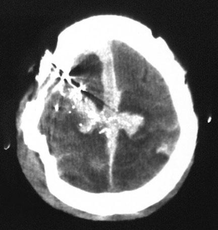 Case #3: Severe TBI Major cause of KIA Often associated with polytrauma & hemorrhage Early blood product-based resuscitation Hypotension &