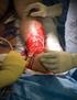 Burn Surgery: Restoring Life to Burn Victims