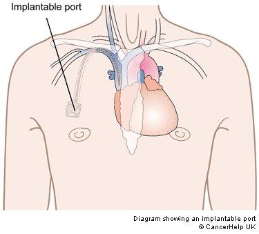 A portacath is a small medical device that is installed beneath the skin. It is made of two parts: 1. A soft, thin hollow plastic tube known as a catheter.