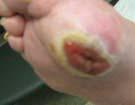 wound healing; it is used along with a diet designed for wound healing and proper wound care.