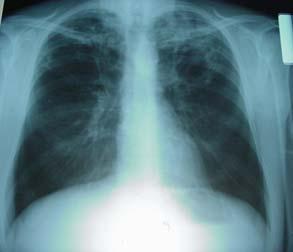 Radiologist Chest Radiograph Reason for CXR: Rule out pneumonia CXR
