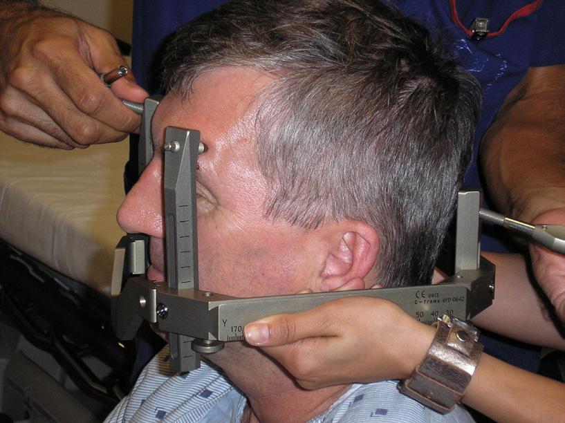1. Putting your head frame on The stereotactic head frame is an important part of your treatment. It will be put on you the morning of your treatment.