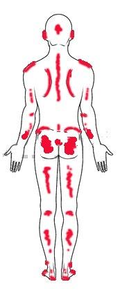 Unit Two Recognising pressure sores. Within your role in the care sector you are likely to come across pressure sores.
