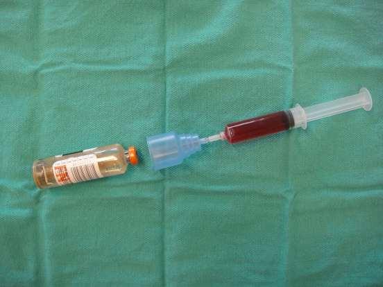 APPENDIX B Blood Withdrawal from Arterial Line Using Syringe NURSING ALERT: If blood cultures are required, they must be drawn by syringe method and transferred into blood culture medium vials.