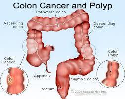 Background Colorectal cancer is the second most common cancer in men and women in Australia One of the most preventable