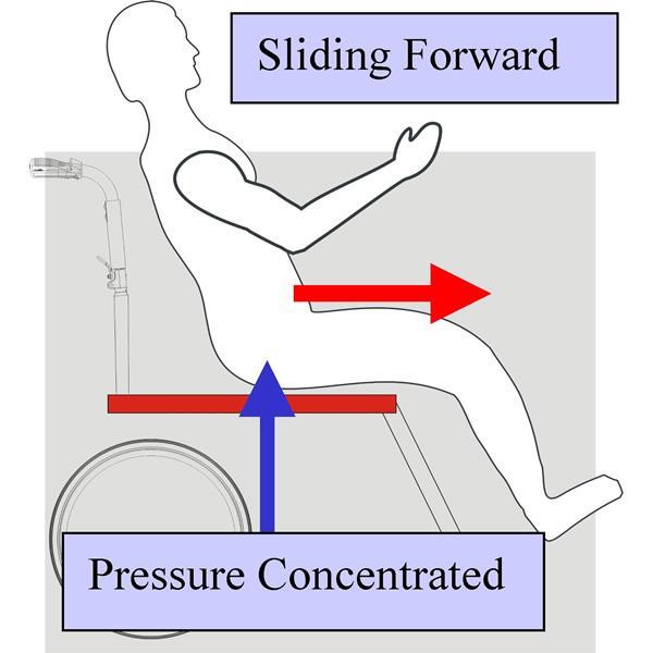 Risk Factor: Immobility in Chair Patients should be shifted/repositioned every hour while up in the chair.