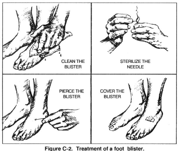 Figure C-2. Treatment of a foot blister. b. Use just enough foot power since it can harden and become irritating.