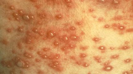 Following a chickenpox infection, the virus may survive in the nerve cells in a dormant form. Shingles occurs only in individuals who have had chickenpox in the past.