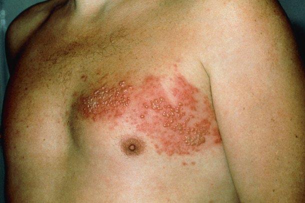 Pain and itching in the area of the affected nerve is often the first symptom followed by a dermatomal (one sided) rash of fluid filled vesicles (blisters).