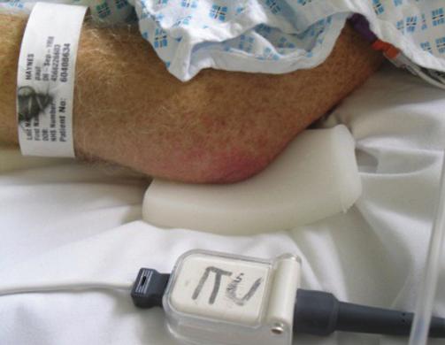 Case study: Safeguarding against pressure damage in a critically-ill patient A 53-year-old male with no significant past medical history was admitted to hospital with pancreatitis of unknown cause,