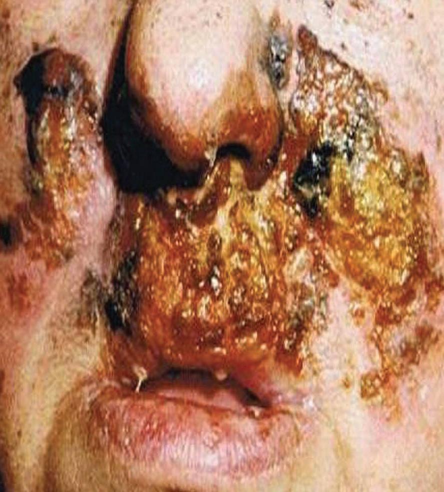 Incidents in London Dec 2013 to Aug 2014 Borough Incident Cause Outcome Comment Page 13 Bromley August 2014 pt burned nose. Patient had facial burns.