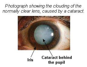 Cataracts can occur at any age and are likely to occur earlier in patients who are diabetic, in those who have