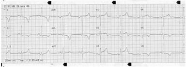 STEMI 1035 EMS notifies ED via radio of patient status and 12 Lead ECG findings 1037 STEMI Alert is activated 1045- EMS arrives and is directed through ED 1047 Patient arrives in Cath Lab 1105 1 st