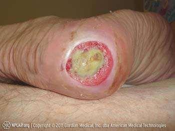 Unstageable Full-thickness skin and tissue loss in which the extent of tissue damage within the ulcer cannot be confirmed because it is obscured by