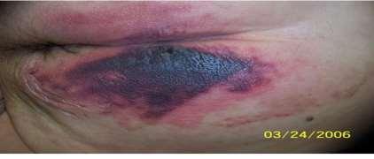 purple discoloration or epidermal separation revealing a dark wound bed or blood filled blister.