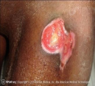 blister. Presents as a shiny or dry shallow ulcer without slough or bruising. Note that bruising may indicate deeper tissue injury.