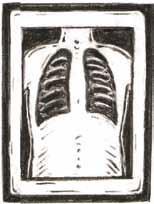 You may have chest tubes after surgery. Chest tubes drain old blood from where you had your surgery. They also help keep your lungs inflated. You will have a chest x-ray each day.