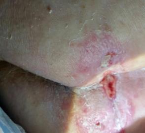 Slide 7 June 2, 2016 Not a clear photo, but a welcome photo to make sure wound is progressing toward closure and that the