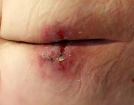 water/lightly scrub wound with normal saline; dry well.