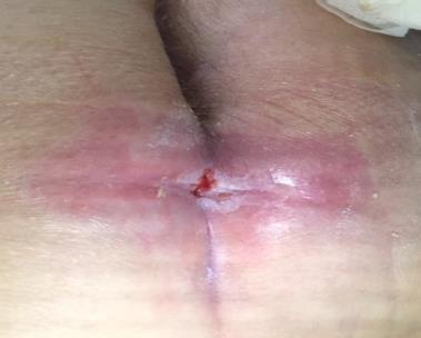 1 cm) and wound bed is less vibrant red, but appears to have healthy peri-wound tissues The agency