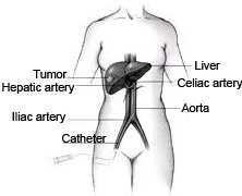 UW MEDICINE PATIENT EDUCATION Angiography: Yttrium-90 Radiotherapy Treatment for liver tumors This handout explains what Yttrium-90 radiotherapy is and what to expect when you have it done.