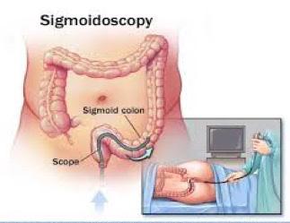 Flexible Sigmoidoscopy It is an examination, which allows the doctor to look directly at the lining of the lower part (rectum and sigmoid colon) of the large bowel.
