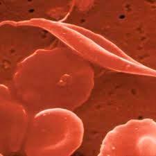 Clinical Scenario: Sickle Cell Trait 20YOBM collapses during FB mat drills c/o dizziness, fatigue, SOB, chest pain and B leg/buttock pain sickle cell trait (+) HX diarrhea/vomiting past 24 hrs.
