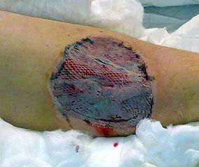 M1311 A pressure ulcer treated with a skin graft (defined as transplantation of skin to another site) should not be reported as a pressure ulcer and until the graft edges completely heal, should be