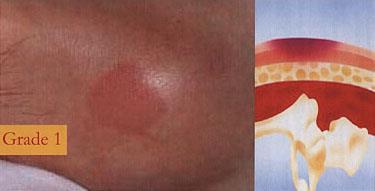 Appendix 3 The EPUAP Guide to Grading Grade 1: non-blanchable erythema of intact skin.
