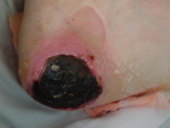 Until enough slough/eschar is removed to expose the base of the wound bed, the true depth cannot