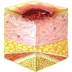 the skin and/or underlying tissue usually over a bony prominence, as a result of pressure, or pressure in combination with shear.