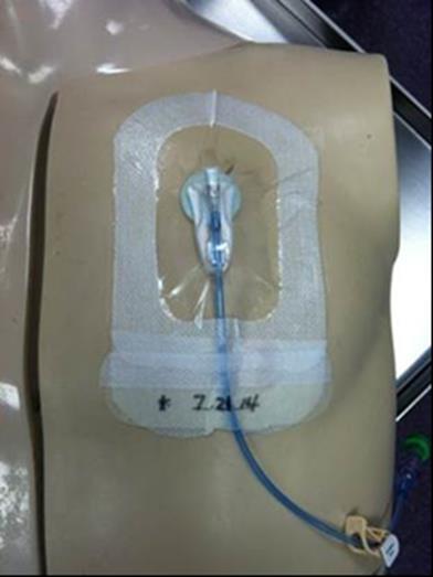 Line Insertion Dressing Standards No gauze on incision site Incisional adhesive with antimicrobial patch or Steri-strips with antimicrobial patch acceptable on incision site Bio-occlusive,