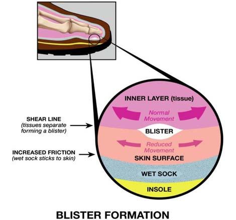 Blister Prevention Blisters are fluid-filled sacks of skin that can be caused by burns (e.g.
