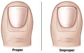 Below are steps to avoid ingrown toenails: Trim the nail straight across.