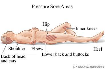 Training Time turning charts for patient door Two nurse review of pressure sore Pressure Sore