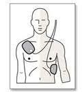o An acceptable alternate placement of electrodes is the anterior-posterior