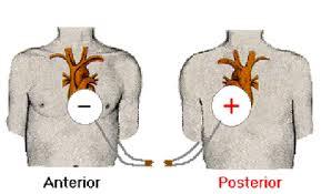 The anterior pad is placed on the left side of the sternum and The posterior pad