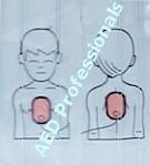 o When placing electrode pads on a patient with an implanted pacemaker or AICD,