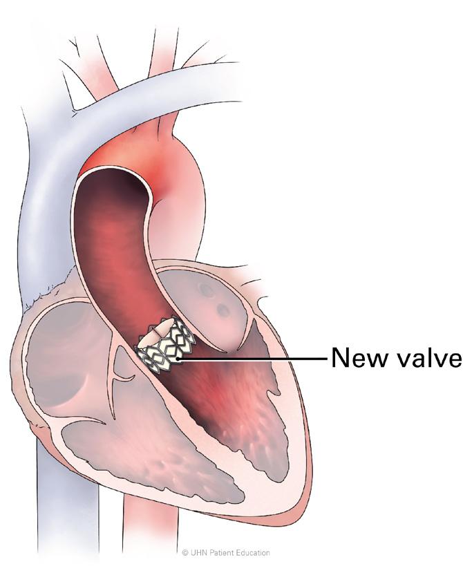 Questions about TAVI What is the TAVI procedure? Trans-catheter Aortic Valve Implant (TAVI ) is the name of the procedure recommended to replace your unhealthy heart valve.