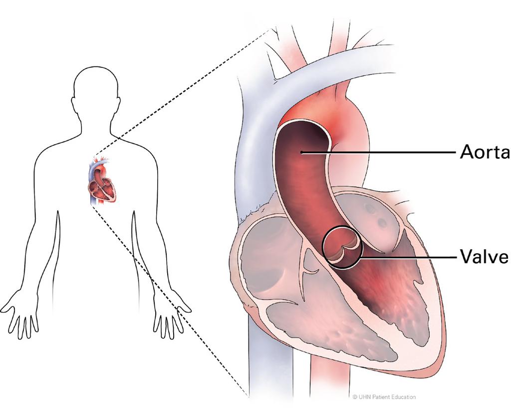 Refers to the aorta, a large artery that carries blood away from the heart to the body. Valves control the flow of blood through the heart.