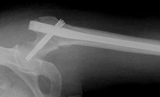Intermedullary hip screw (nail and screw) The doctor will explain to you which group of fracture you fall into.