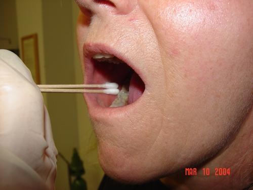 Buccal Control Swabs p p p ü Done to collect Victim