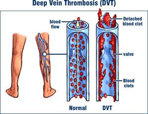 DVT Prevention: Blood clots SCD s (sequential compression devices may be used to prevent the formation of clots Anti-embolism hose or Ted Hose may be used on opposite leg w/knee and may be used