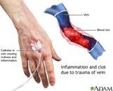 Complications http://www.medicaljournals.se/acta/content /?doi=10.2340/00015555 0420&html=1 7 INS Extravasation Guidelines 8 Infiltration Site edematous, hard, painful to touch.